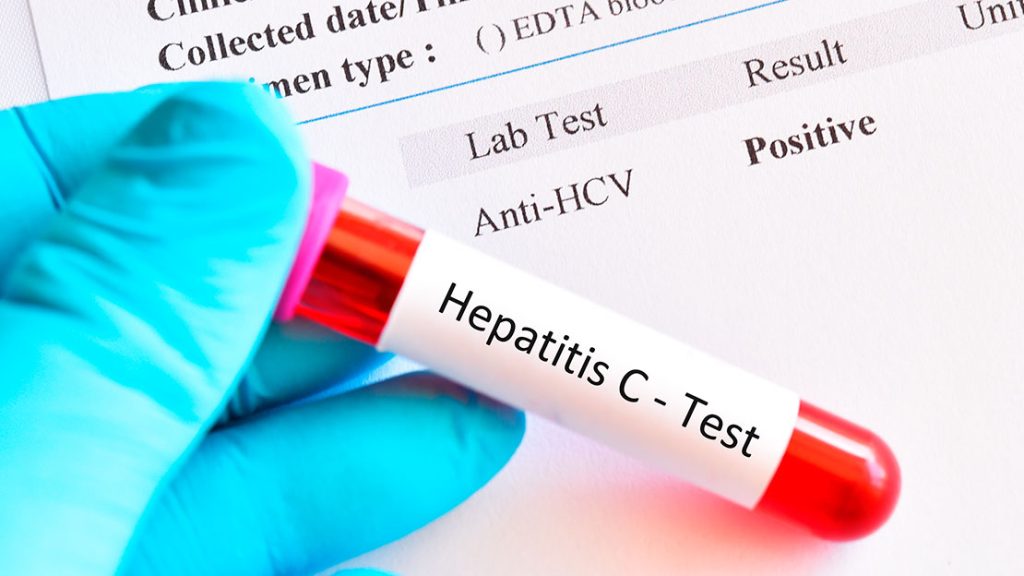 Test d'hepatitis / Calderón
