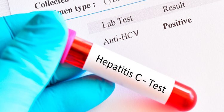 Test d'hepatitis / Calderón